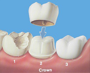 Understanding Dental Crowns Basics