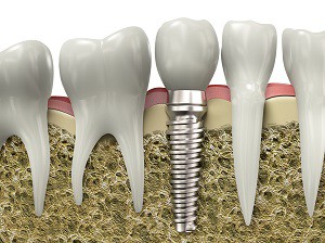 Dental Implants Can Make All The Difference