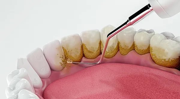 What to Do If You Have Periodontal (Gum) Disease?