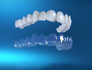 Modern Type of Teeth Straightening Technology