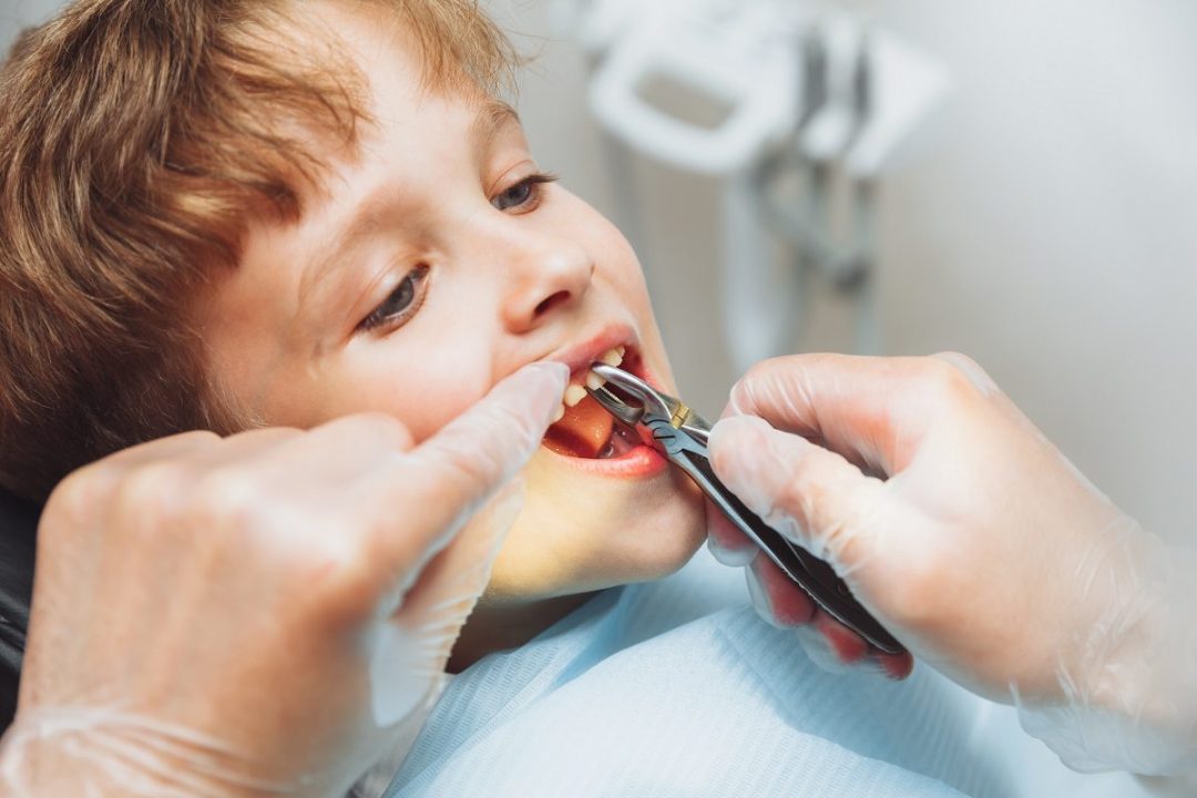 Advantages & Disadvantages of Tooth Extraction 