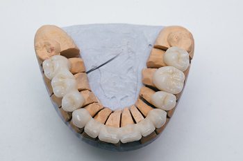 Porcelain Dental Veneers