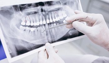 How Much Do Full Mouth Dental Implants Cost?