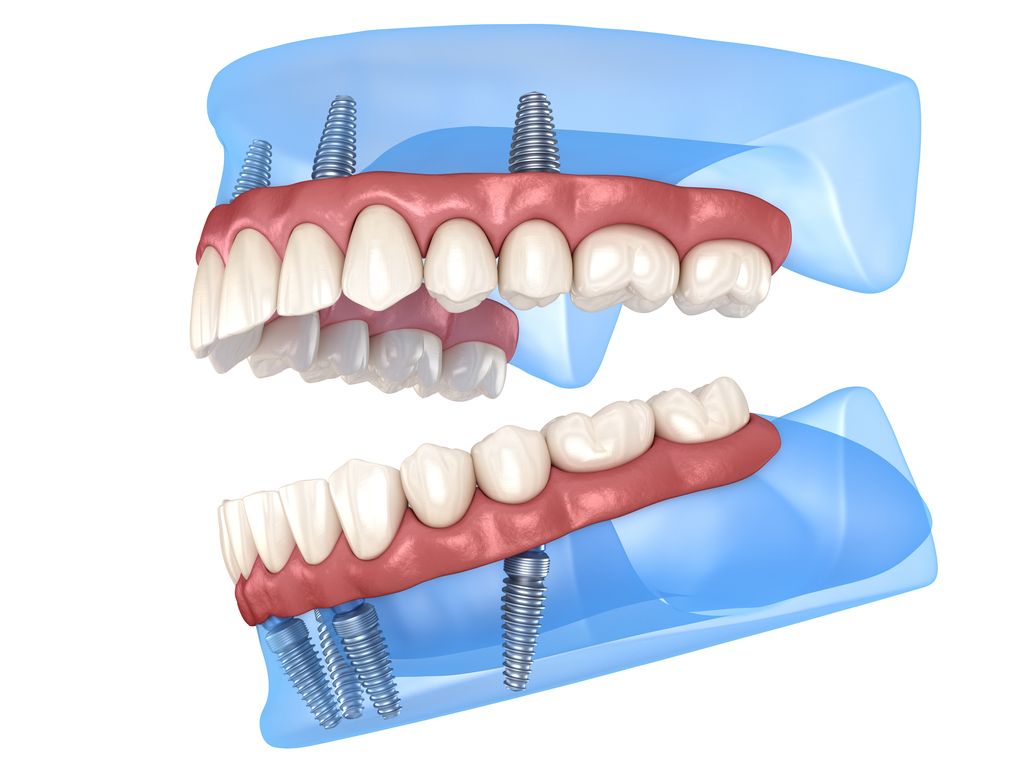 All-On-Four Compared to Dentures