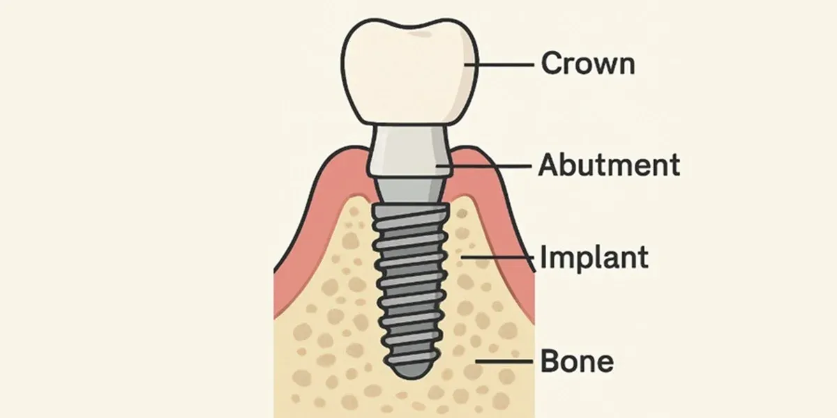 Best Dental Implant in Walnut Creek