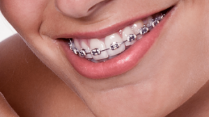 A Significantly Large Overbite or a Vertical Movement