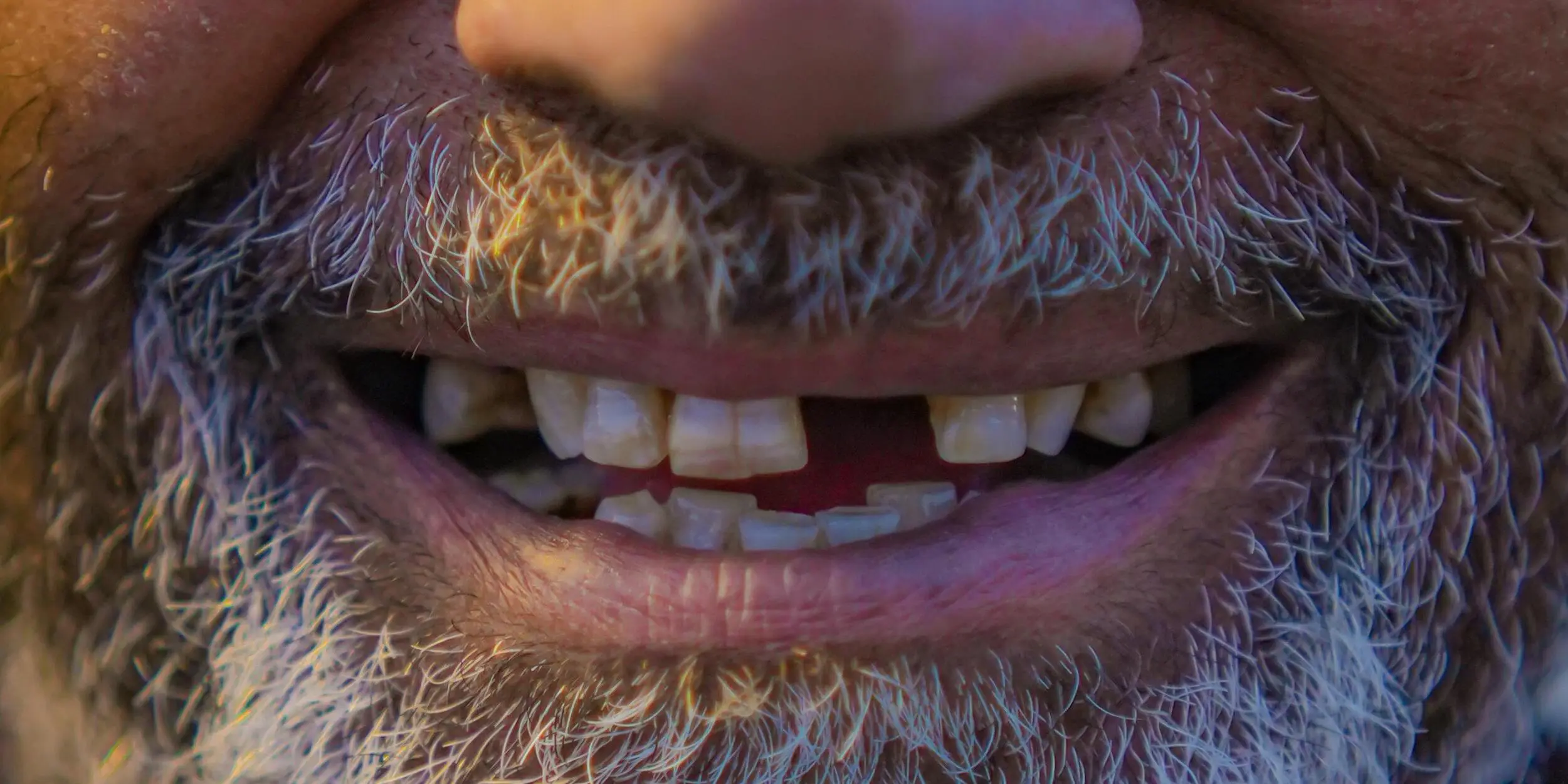 Dental Implant
