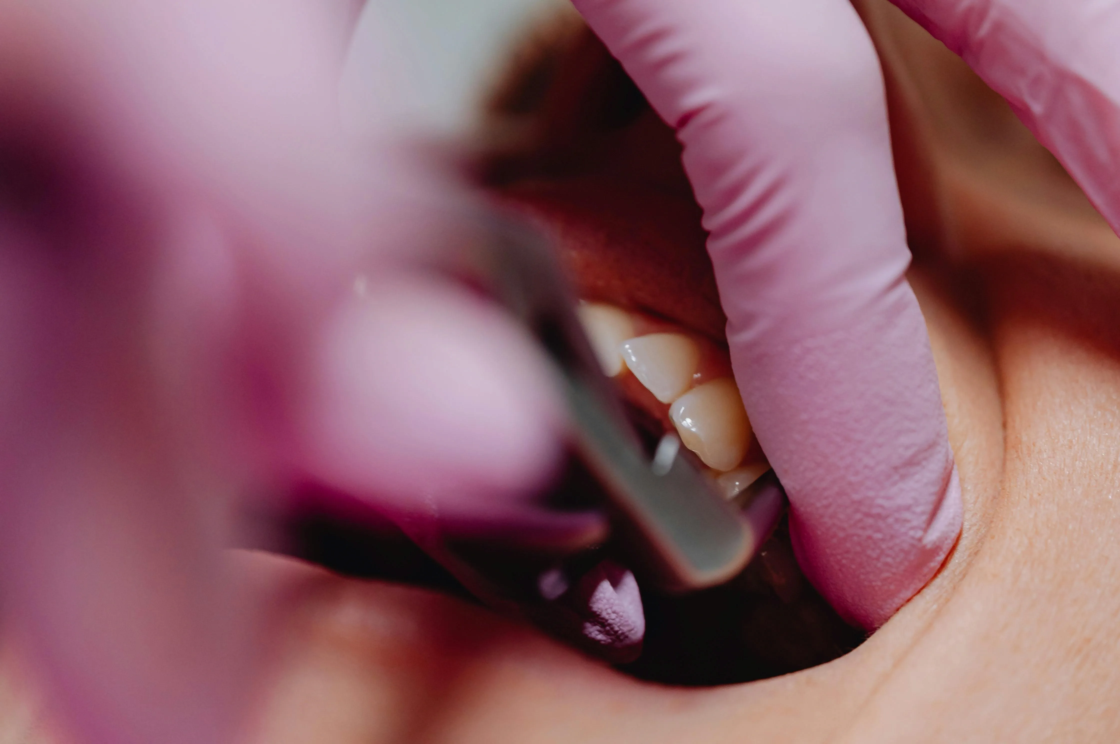 Dental implants
