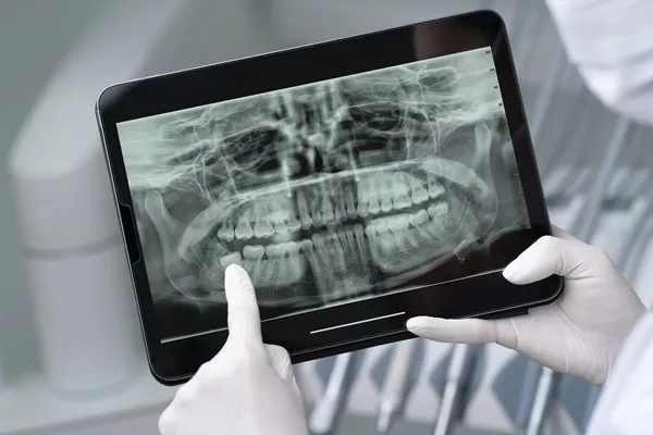 Dental implants