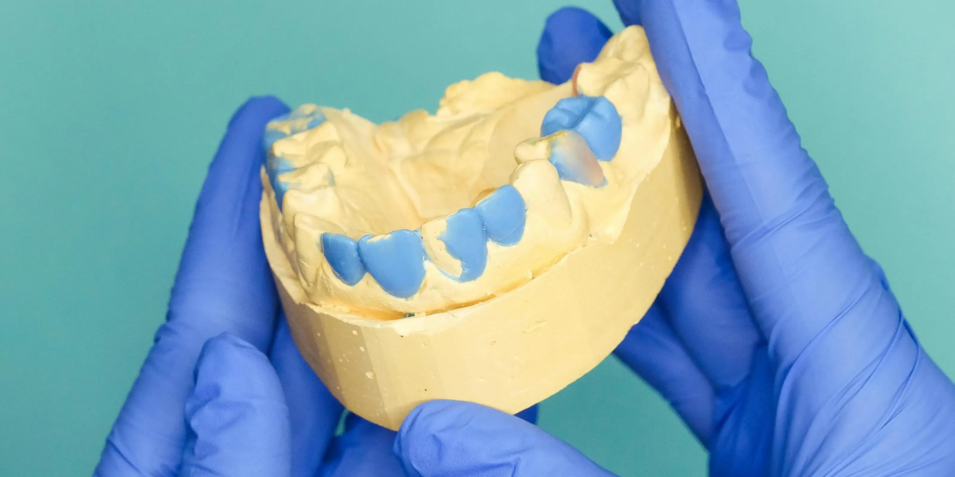 Dental Implant