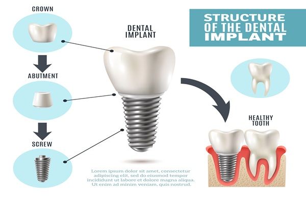 Dental Implant