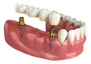 Multiple Missing Teeth and Dental Implant Options