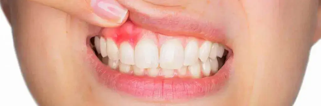 Gum Disease, Signs and Diagnosis