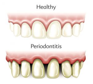 Healthy gum vs periodontitis 