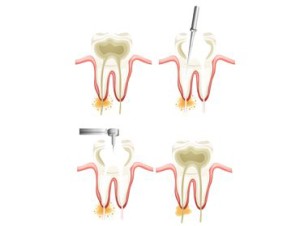 Advanced Endodontic Treatment