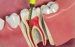Root Canal Procedure Explained