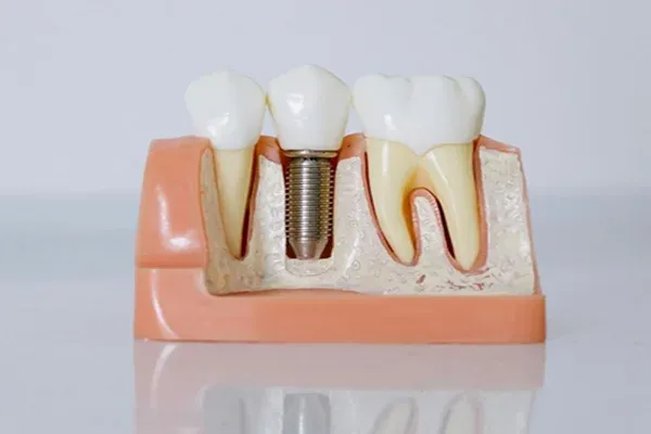 Single tooth implant