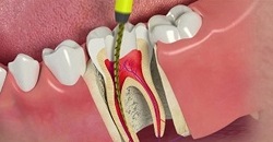 How Long Does a Root Canal Therapy Take?