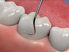 Fluoride Treatment as a Way to Further Protect Teeth
