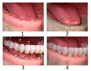 Understanding the Full Jaw Restoration Process