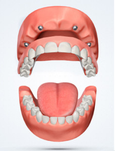 Carefully and Precisely Rebuilt Teeth