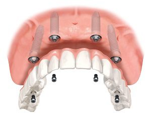 Removable Dentures  vs All on Four