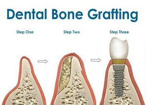How Does a Dental Bone Graft Work
