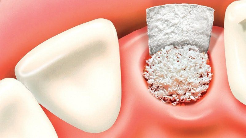 Bone Graft Before Dental Implant