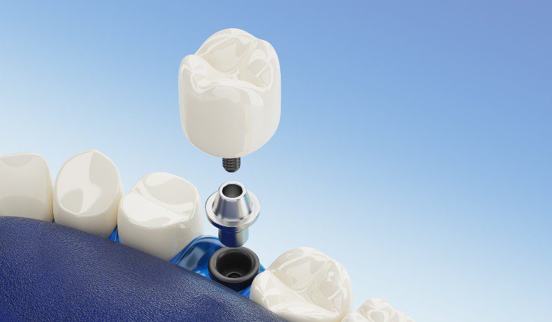 Modern Dental Implant Techniques