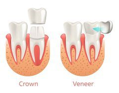 Differences Between Dental Crowns and Veneers
