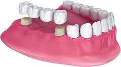 Dental Bridges Pros And Cons