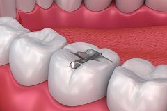 Removing Restorations that are Performing Well