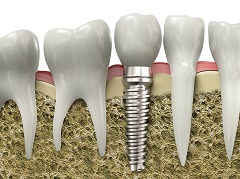 Why Consider Dental Implants?