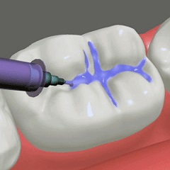 The Earlier Dental Sealants Are Applied The Better