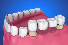 Restoration Options for Missing Teeth