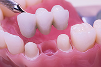 Teeth are More Susceptible to Fracture and Tooth Decay