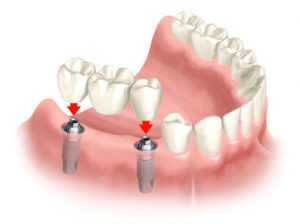 Fixed Bridge over Dental Implant