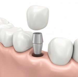 How Long Does a Dental Implant Placement Take?