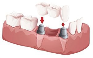 Hold In Place an Artificial Tooth