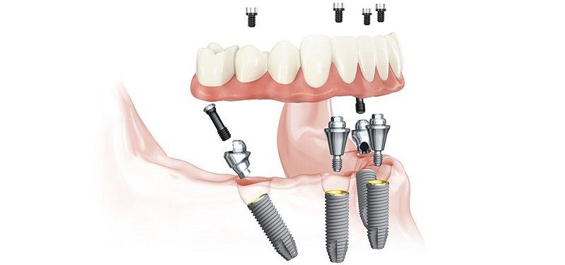Full Jaw Restoration: All On Four Vs Dentures