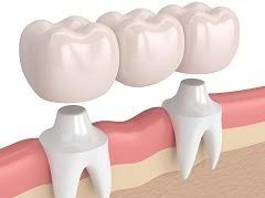 Permanent Dental Bridges Vs Partial Dentures