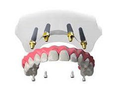 An Anchor Point To Place Artificial Teeth