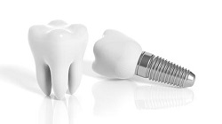 Dental Implants: Secure and Permanent Placement