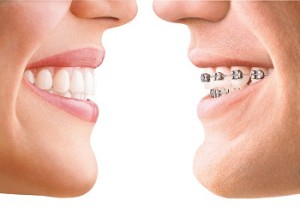 Excellent Teeth-Straightening Technology