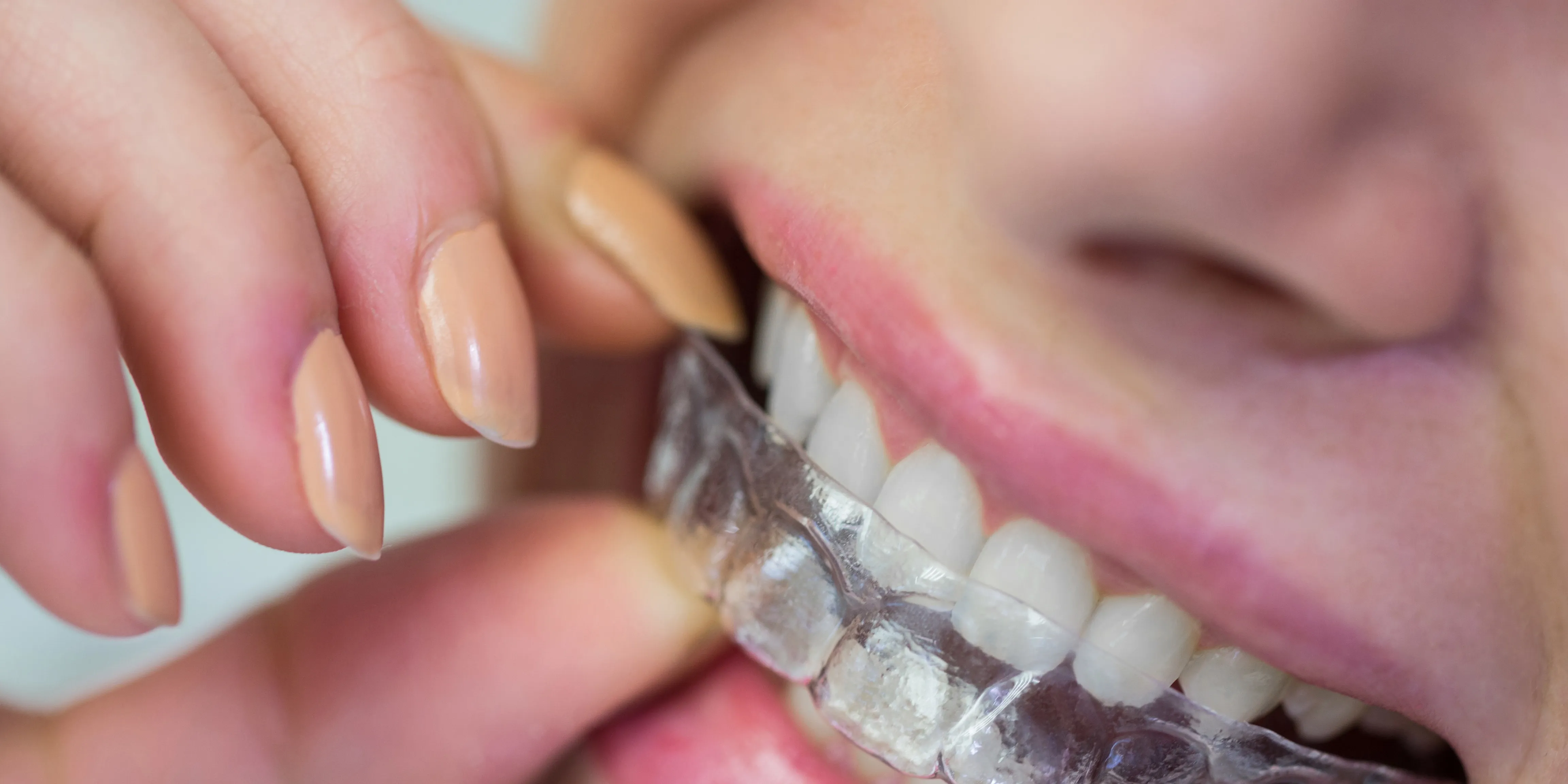 invisaling treatment