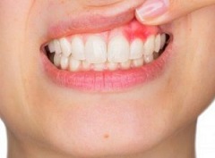 Gum Diseases and Their Effect on Pregnancy