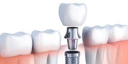 How Long Does a Dental Implant Procedure Take?