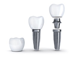 Basic Facts About Dental Implants