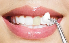 Correcting Chips and Cracks In The Actual Tooth Enamel