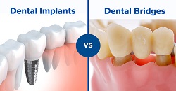 Dental Implant Success Rates as Related to Dental Bridges